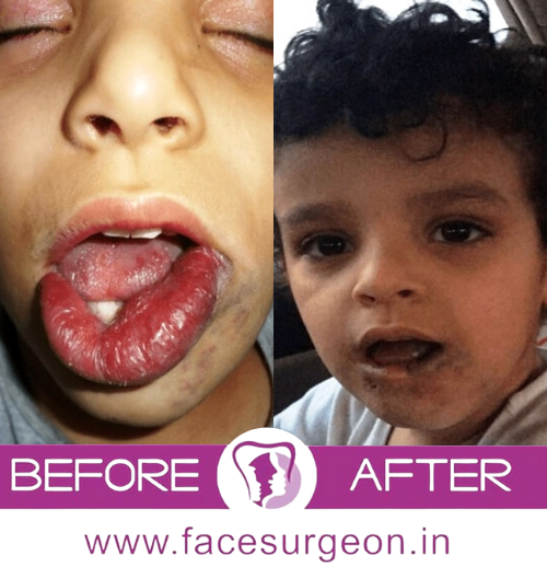 Before and After Hemangioma Surgery in India