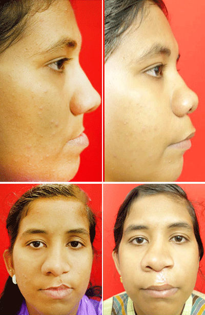 AMD Orthognathic Surgery in India