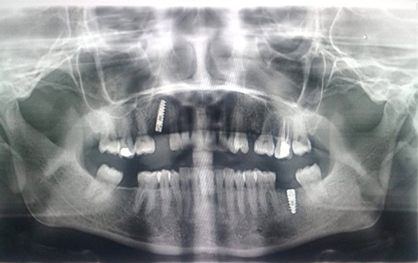 dental implants treatment in Nagercoil Xray