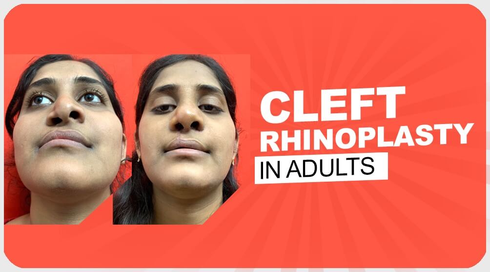 Cleft Rhinoplasty