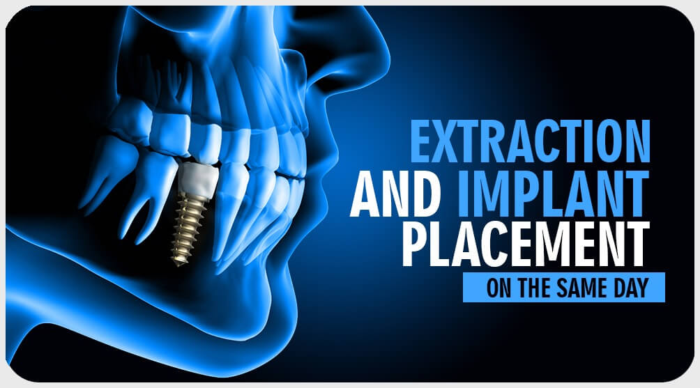 Extraction and Implant placement on the same day