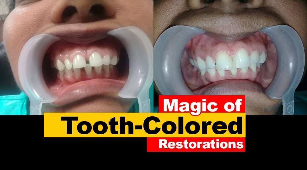 Magic of Tooth colored Restorations or Fillings