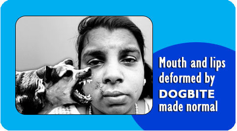 Mouth and lips deformed surgery in India