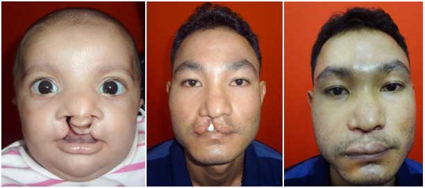 cleft lip surgery specialist in india