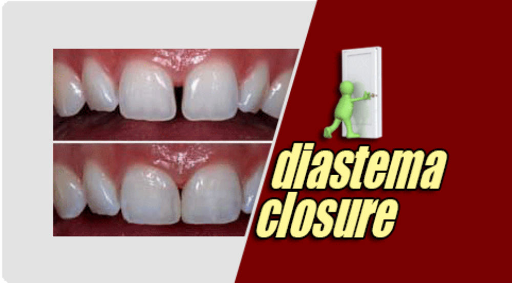 diastema closure treatment
