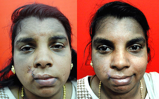 mouth and lip deformed surgeon in India