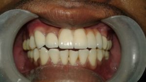 After Dental Rehabilitation Treatment in India