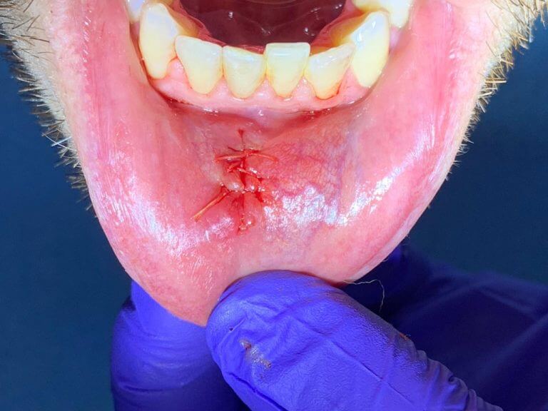 After Intra Oral Biopsy