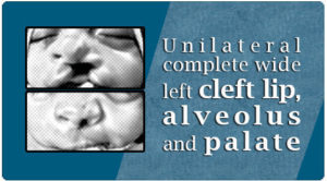 Alveolus cleft lip palate surgery in India