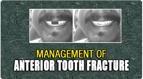 Anterior Tooth Fracture Treatment in Tamil Nadu