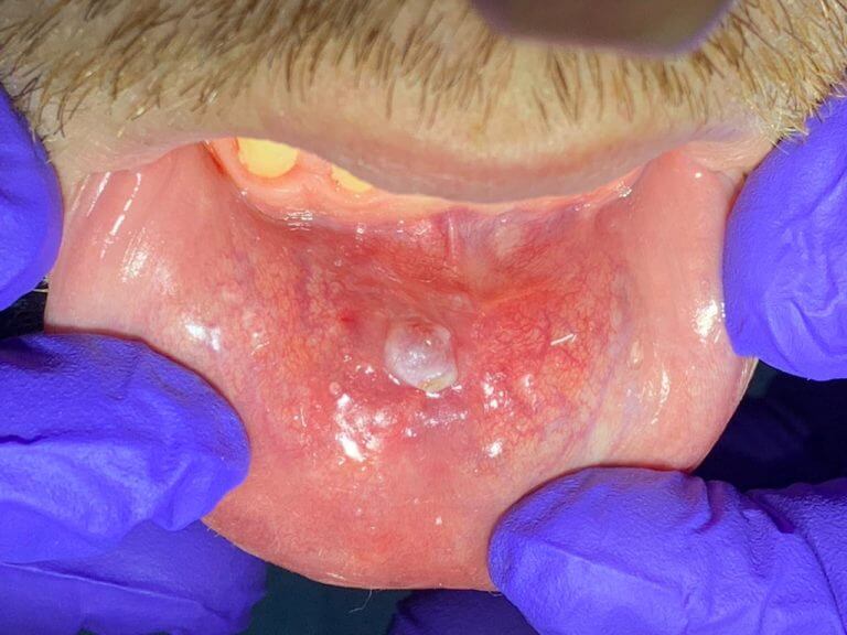 Before Intra Oral Biopsy