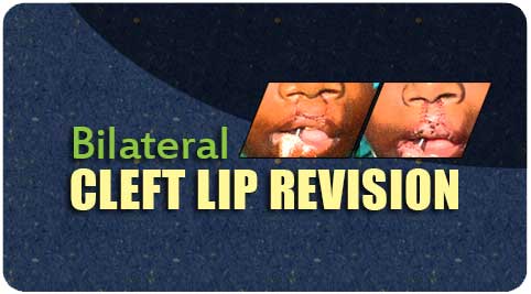 Bilateral cleft lip revision Surgery in India
