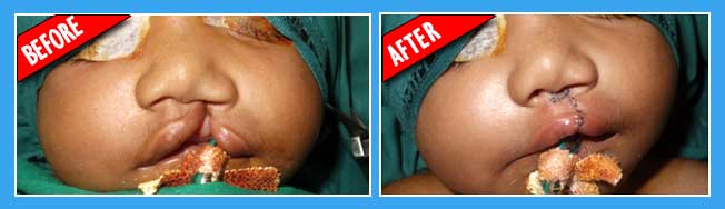 Cheiloplasty surgery in India