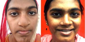 Cleft Lip Surgery in Nagercoil