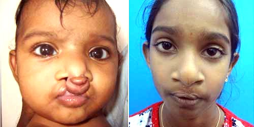 Cleft Nasal Rhinoplasty in India