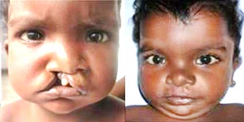 Cleft Nasal Rhinoplasty in Tamil Nadu