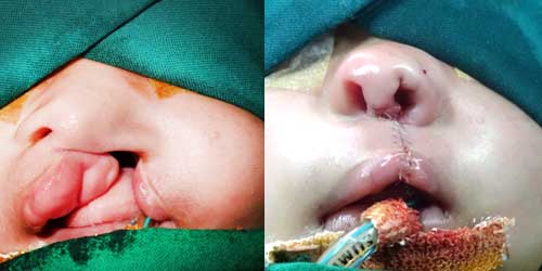 Cleft nasal deformity