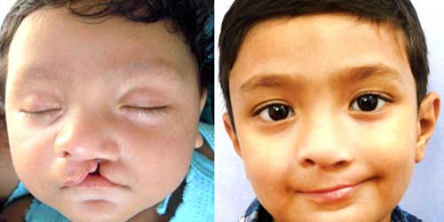 cleft nose surgery in india