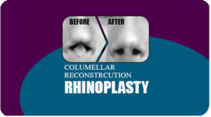 Columellar-Reconstrcution-Rhinoplasty