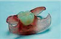 Denture made up of acrylic