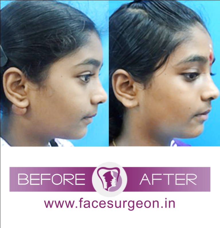 Ear Keloid Otoplasty Treatment in India