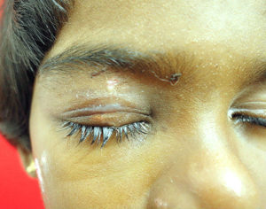 Eyelid surgery in India