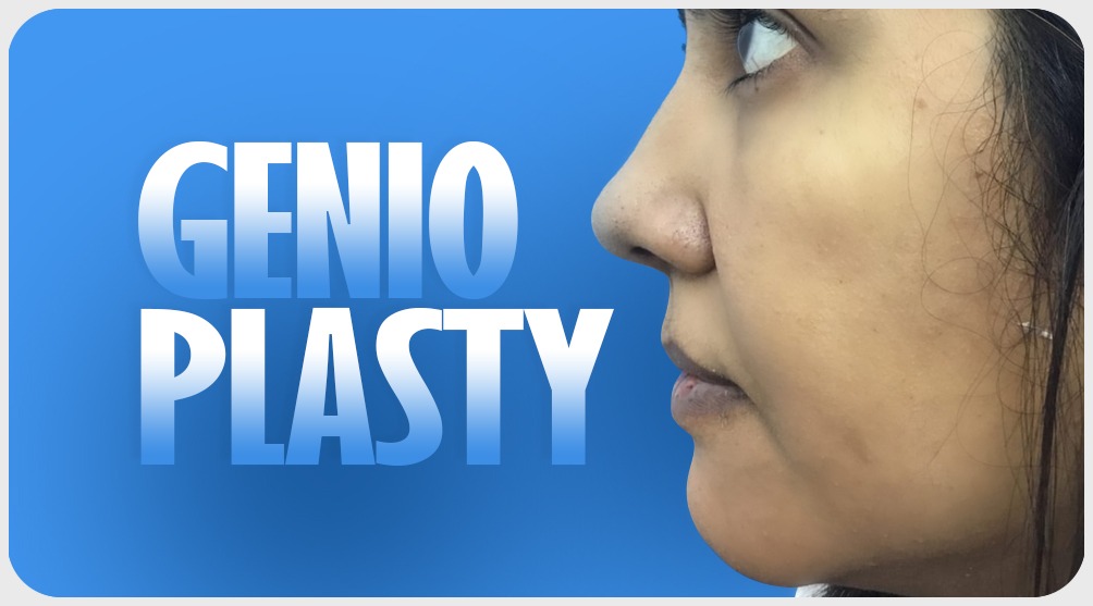 Genioplasty Treatment in India