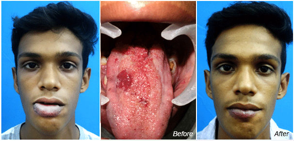 Hemengioma Surgery in India