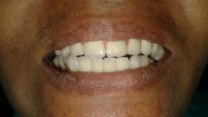 hybrid dental implants in india