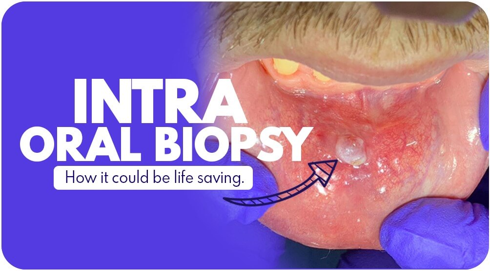 Intra Oral Biopsy