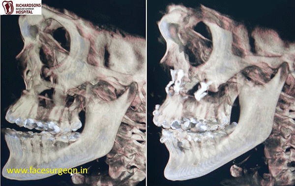 Jaw Surgery in India