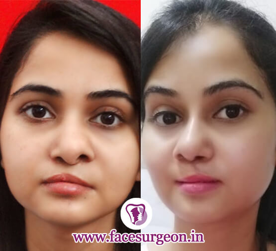 Lip Revision Surgery in Tamil Nadu