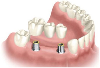 dental implant surgeon in Nagercoil