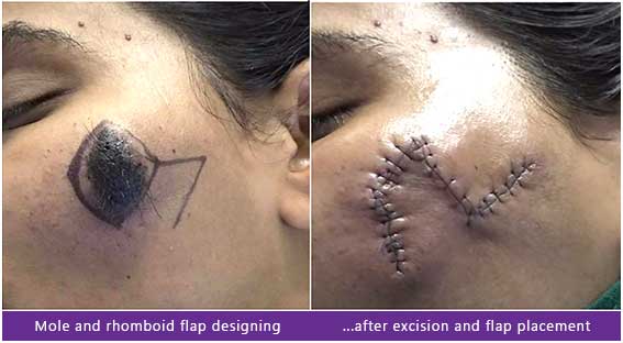 Mole removal surgery in India