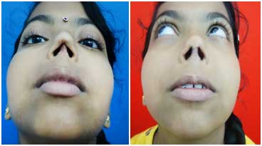 nose surgery in tamilnadu