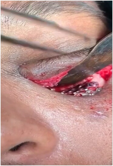 Orbital floor implant surgery in India