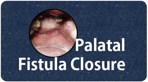 Palatal Fistula Closure treatment in Tamil Nadu