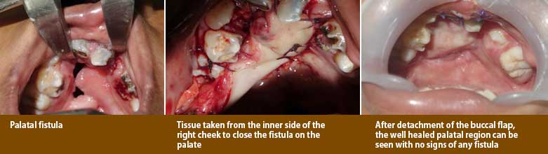 Palatal fistula treatment in India