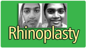 Rhinoplasty(nose job) Surgery in Tamil Nadu
