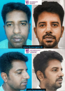 rhinoplasty surgeon in south india