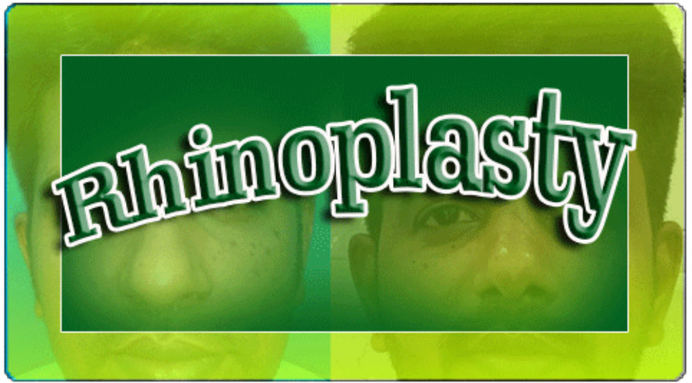 Rhinoplasty cover image