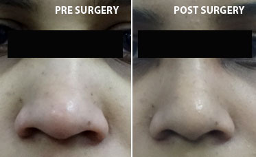 Rhinoplasty surgery in India
