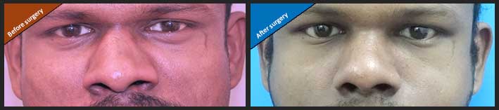 Rhinoplasty surgery in Nagercoil