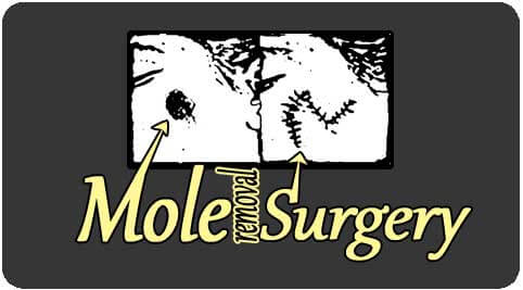 Surgery for mole removal in India