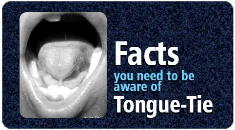 Tongue tie treatment in India