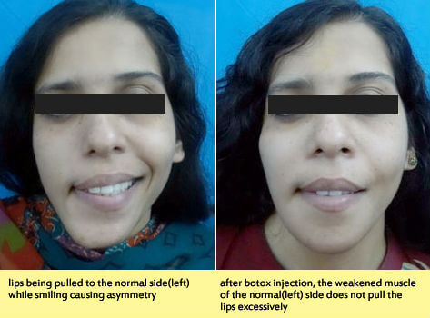 Treatment for facial asymmetry correction in India