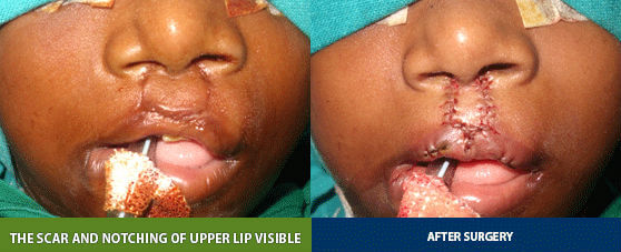 bilateral cleft lip correction surgery in India