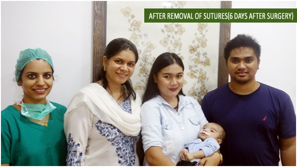 cleft lip treatment in India