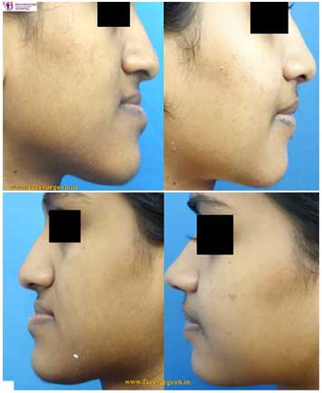 corrective jaw surgery in India