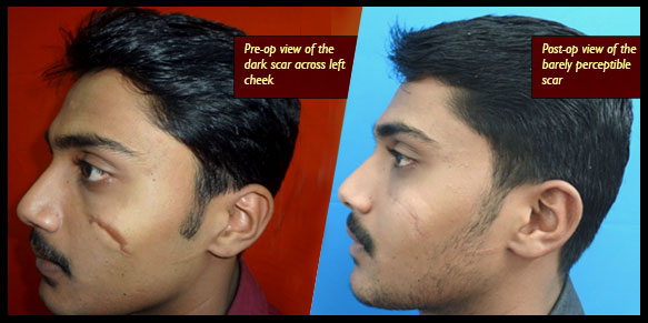 facial scar removing treatment in India
